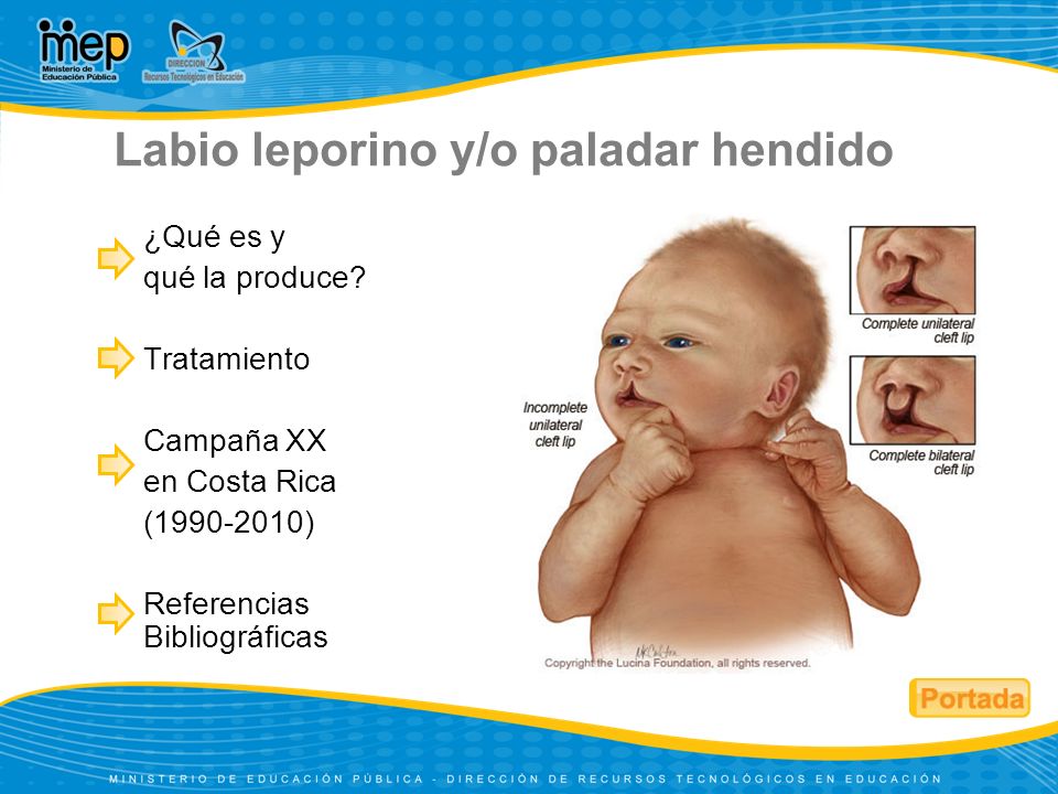 Causas de labio leporino y paladar hendido